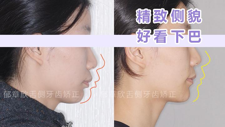 下巴后縮矯正方法詳解，下巴后縮矯正方法全面解析