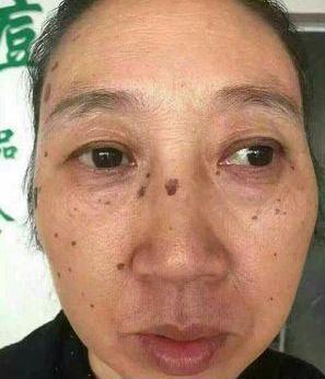 去老年斑的簡單方法，重拾肌膚光彩的秘訣，去老年斑秘籍，重拾肌膚光彩的簡易方法