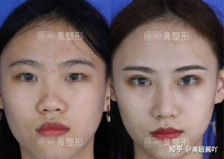 成都隆鼻專家前十名，專業(yè)技藝與信譽并重，成都隆鼻專家前十名，技藝與信譽并重的專業(yè)醫(yī)師