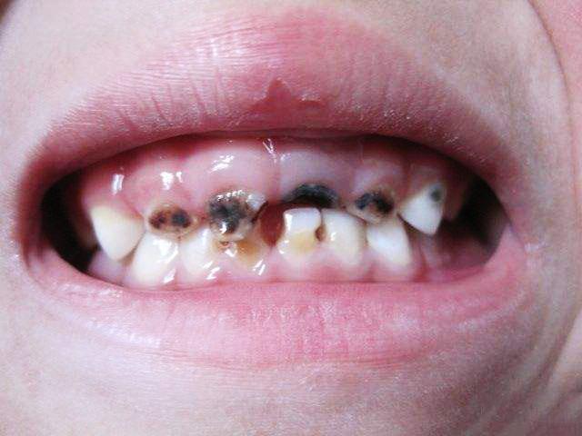 初期蛀牙的樣子圖片，了解并預(yù)防牙齒的隱形威脅，初期蛀牙圖片展示，認(rèn)識并預(yù)防牙齒隱形威脅