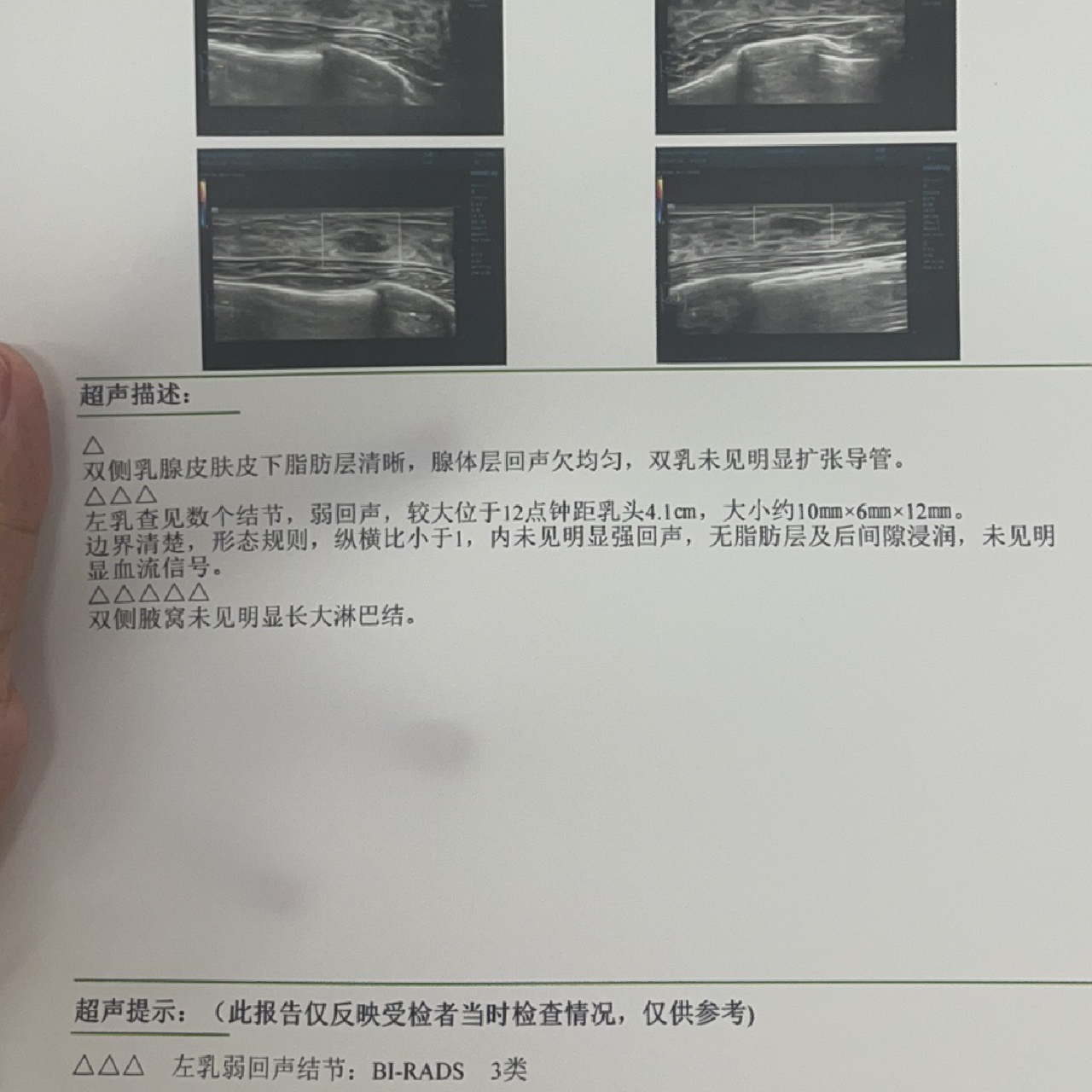 乳腺結(jié)節(jié)3類嚴(yán)重嗎？解讀乳腺健康，讓你了解真相，乳腺結(jié)節(jié)3類嚴(yán)重嗎？解讀乳腺健康真相