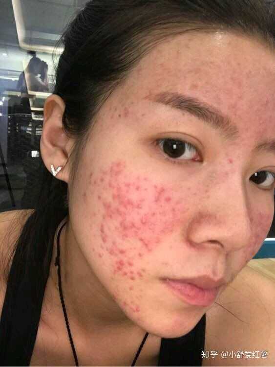 如何有效去除臉上的痘印——全方位指南，全方位指南，如何有效去除臉上痘印的方法