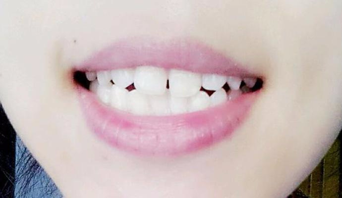 自然縮小門牙縫的方法，有效且實(shí)用的建議，自然縮小門牙縫的有效實(shí)用方法