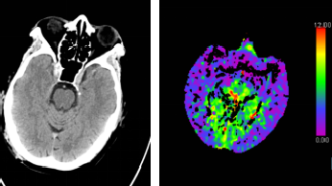 腦CT沒(méi)事就代表大腦沒(méi)事嗎？深入探討腦部健康與CT檢查的關(guān)系，腦部健康與CT檢查，CT無(wú)異常是否代表大腦無(wú)隱患？