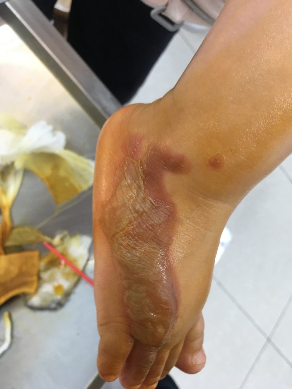 燙傷后如何選用最佳藥膏，避免留下疤痕，燙傷藥膏選擇與疤痕預(yù)防，燙傷后的最佳護(hù)理指南