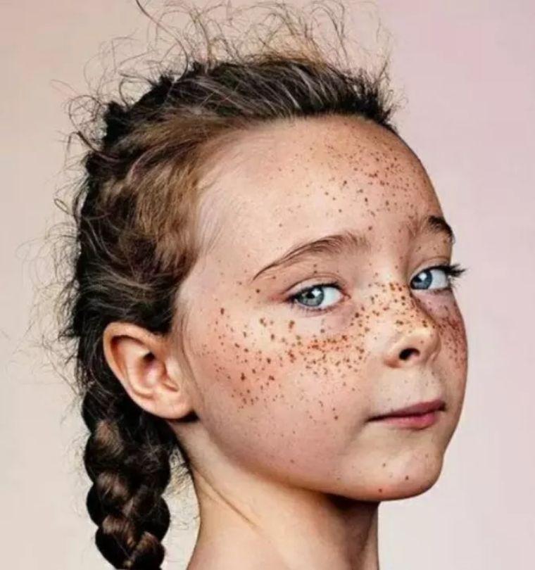 重度痤瘡小偏方，自然療法助你擺脫皮膚困擾，自然療法小偏方助擺脫重度痤瘡皮膚困擾