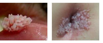 女性尖銳的病圖片，了解、預(yù)防與應(yīng)對，女性尖銳濕疣，圖片解析、預(yù)防與應(yīng)對策略