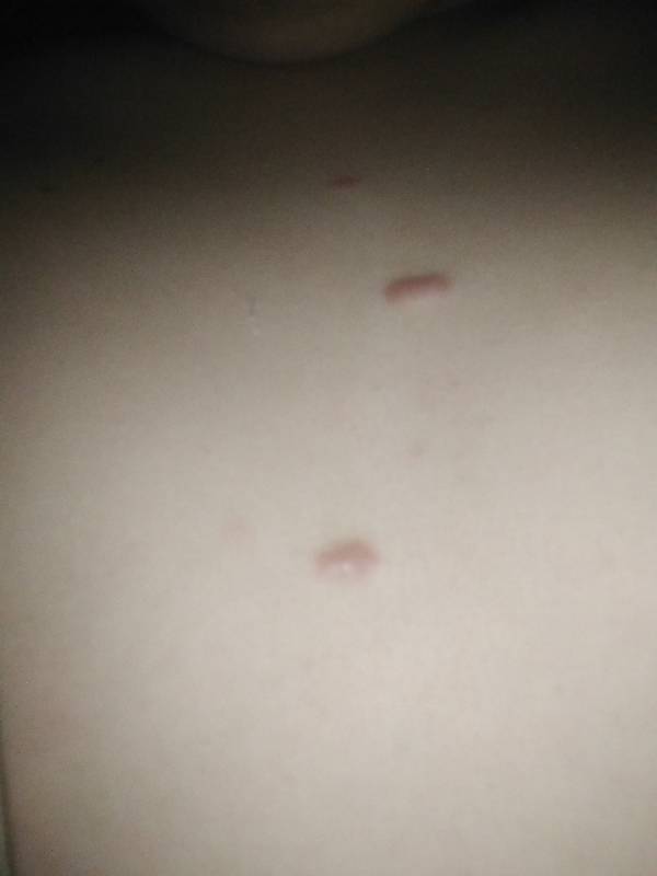 下面長了一個硬疙瘩一碰就疼，原因、診斷與治療方法，私密部位硬疙瘩，成因、診斷與治療方法