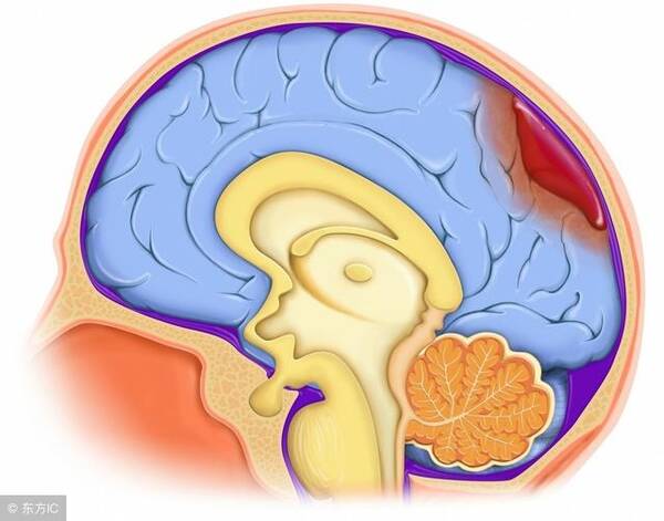 腦出血后遺癥有哪些，腦出血后遺癥的類型與表現(xiàn)