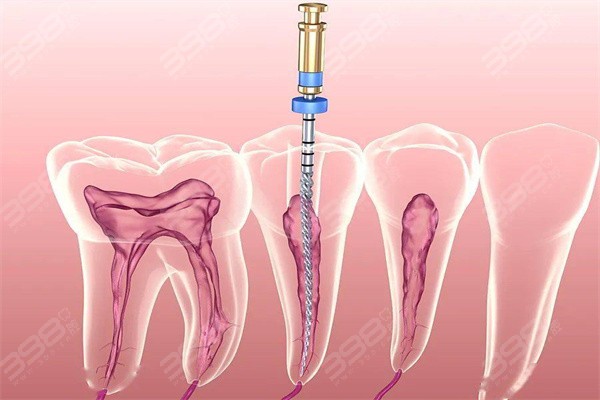 牙齒治療費(fèi)用詳解