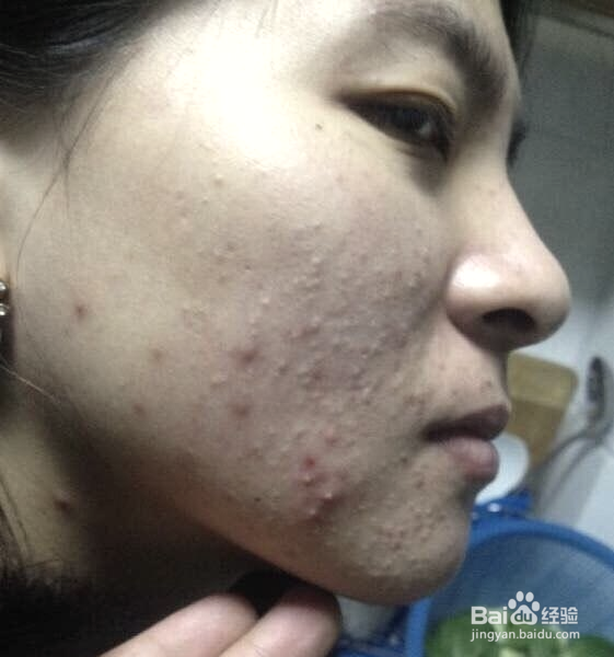 如何快速消除痤瘡，全面解析及實用建議，全面解析消除痤瘡秘訣，實用方法與建議助你快速告別肌膚困擾