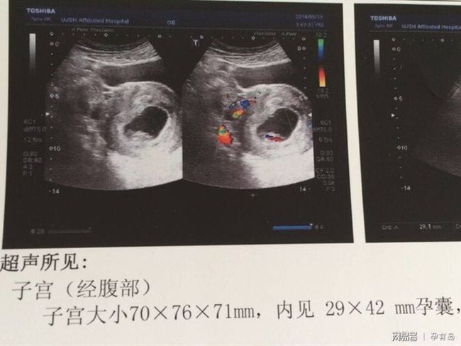 有卵黃囊基本就穩(wěn)了，早期妊娠的穩(wěn)固跡象與注意事項，早期妊娠的穩(wěn)固跡象，卵黃囊出現(xiàn)后的穩(wěn)定與注意事項