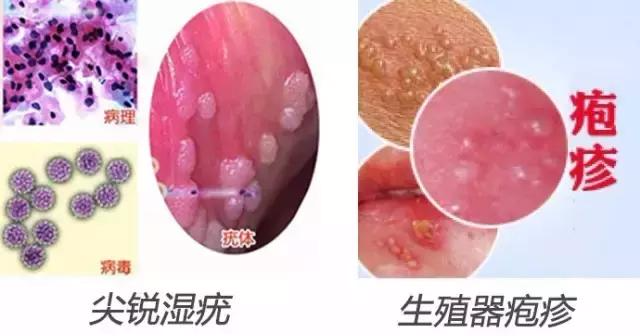 男性尖銳濕疣初期圖片及其相關(guān)解析，男性尖銳濕疣初期圖片及癥狀解析