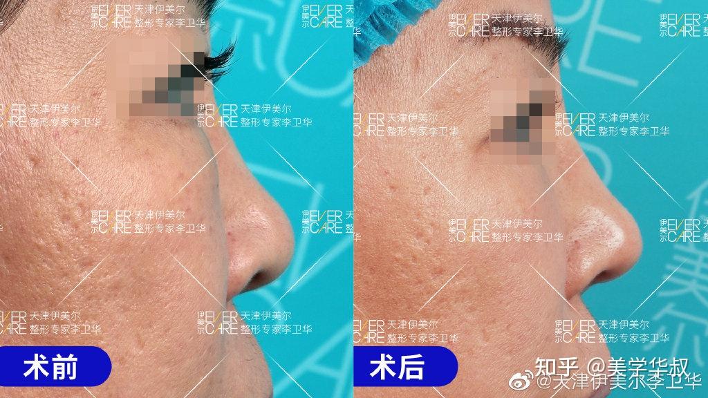 捏鼻三年，鼻頭變大——深度解析捏鼻子對鼻子的影響及應對之策，捏鼻三年的影響，鼻頭變大原因解析與應對之策