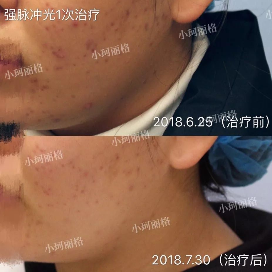 粉刺痤瘡怎樣徹底治愈，全面解析與有效方法，粉刺痤瘡全面解析，如何徹底治愈與有效防治方法