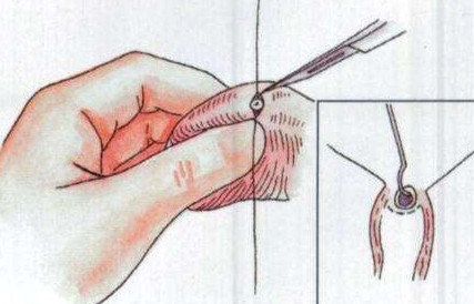 結(jié)扎手術后能否恢復生育能力，解析可能性與關鍵因素，結(jié)扎手術后恢復生育能力的可能性與關鍵因素解析