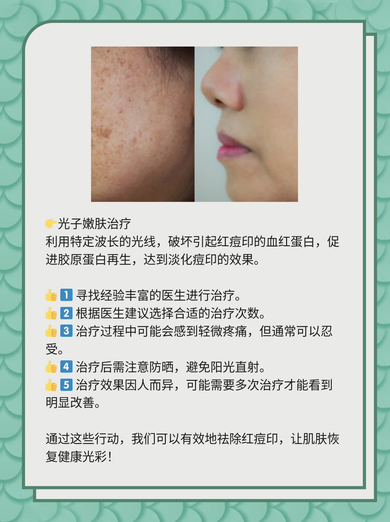如何有效去除紅痘印，一站式解決方案，一站式解決紅痘印問(wèn)題，有效去除方法大全