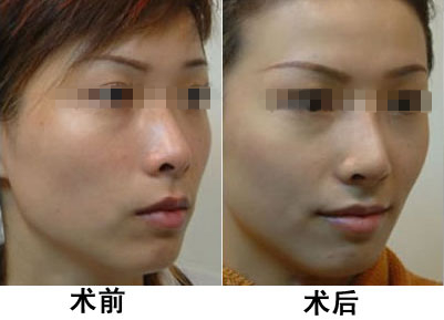 光子嫩膚做一次有效嗎？深入了解光子嫩膚的效果與過程，光子嫩膚效果與過程解析，做一次是否有效？