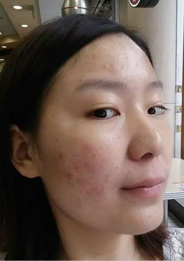 如何有效去除臉上痘痘——多種方法助您重拾肌膚光彩，多種方法助您有效去除臉部痘痘，重拾肌膚光彩