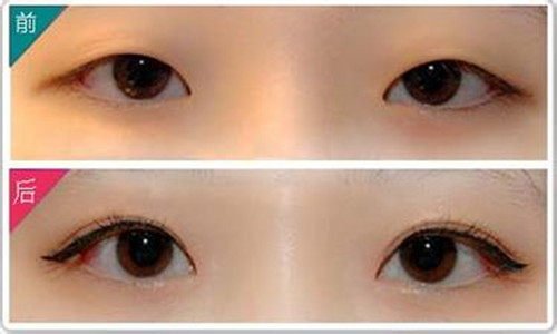 埋線雙眼皮手術(shù)費(fèi)用詳解，價(jià)格因素與如何選擇合適的醫(yī)療機(jī)構(gòu)，埋線雙眼皮手術(shù)費(fèi)用解析，價(jià)格因素與醫(yī)療機(jī)構(gòu)選擇指南