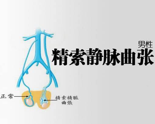精索靜脈曲張的癥狀表現(xiàn)及其影響，精索靜脈曲張的癥狀表現(xiàn)及其潛在影響