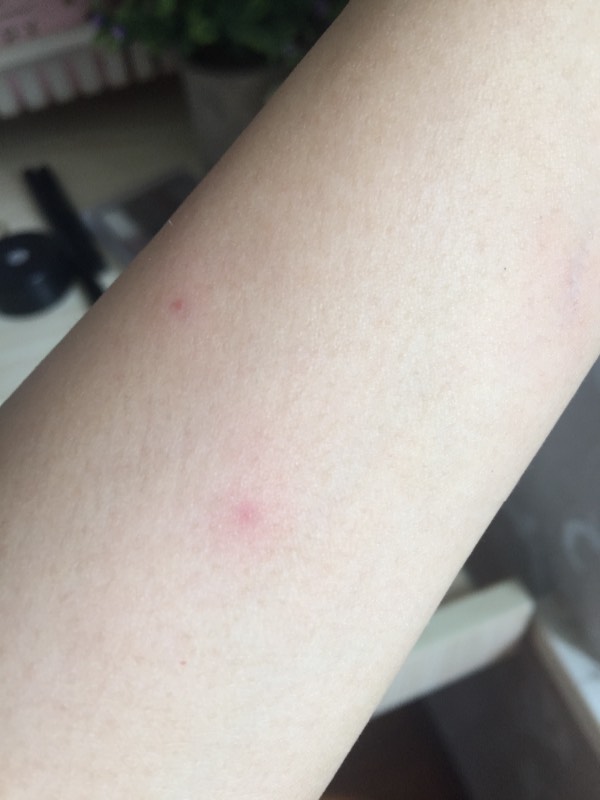 身上紅點不痛不癢圖片，原因、識別與處理方法，身上紅點無痛癢，識別、原因及處理方法