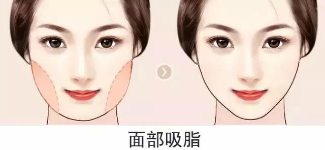 吸脂手術(shù)，是否會反彈及副作用解析，吸脂手術(shù)解析，反彈風(fēng)險(xiǎn)與副作用探討