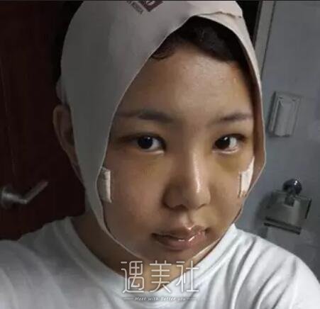 磨骨一年后的驚人變化，對比照片揭示細節(jié)，磨骨一年后的驚人變化，細節(jié)對比揭示驚人效果