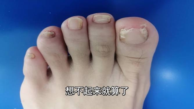 灰指甲由輕到重的圖片展示與解析，灰指甲病情進展圖片展示及解析