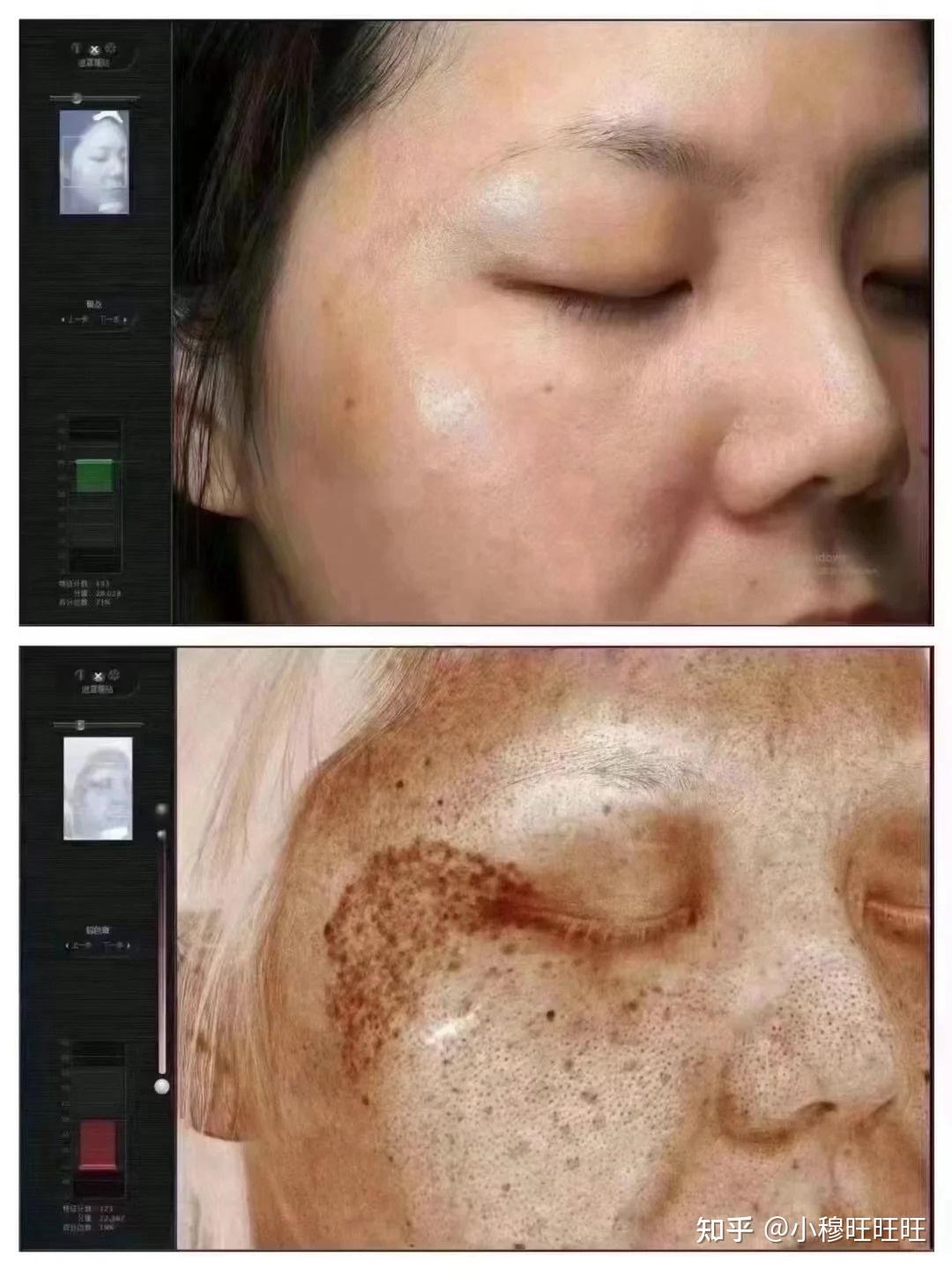 激光祛斑，選擇醫(yī)院還是美容院？全面解讀助您做出明智決策，激光祛斑，如何選擇醫(yī)院與美容院？全面解讀為您指明決策方向