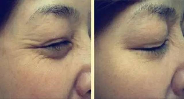 肉毒素除皺的副作用深度解析，肉毒素除皺副作用深度解析