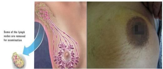 如何排除乳腺癌，自我預(yù)防與早期發(fā)現(xiàn)的重要性，如何預(yù)防與早期發(fā)現(xiàn)乳腺癌，自我檢查與重要性解析