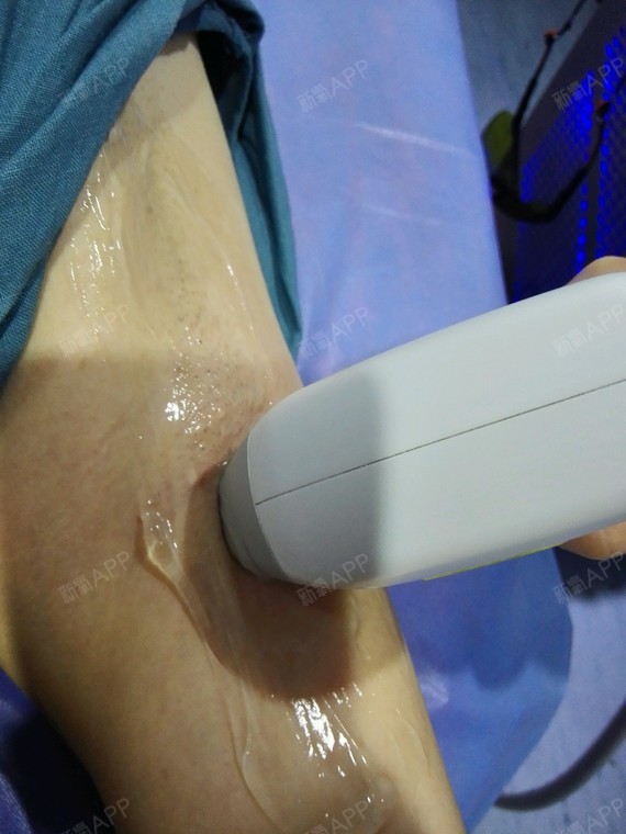 激光脫毛，疼痛感受與體驗解析，激光脫毛，疼痛感受與體驗詳解