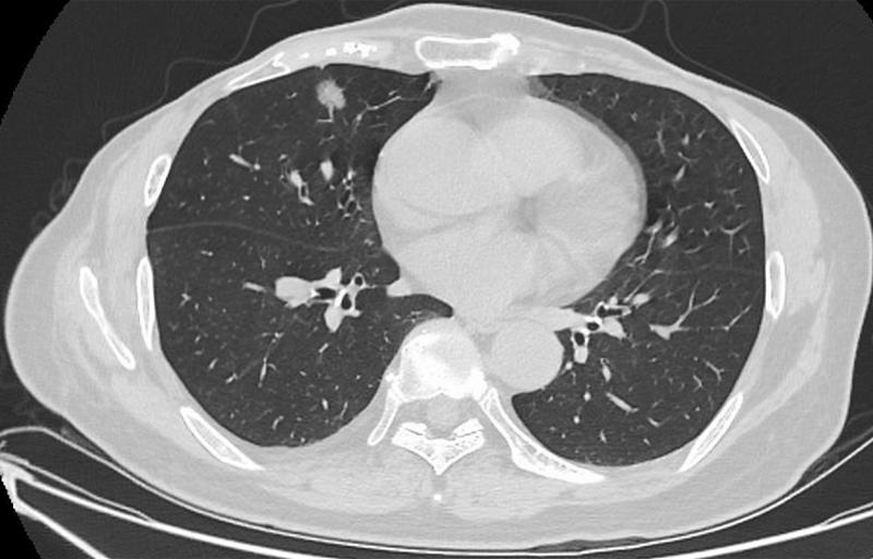 肺結(jié)節(jié)最佳治療方法，全面解析與你的健康之路，肺結(jié)節(jié)最佳治療方法詳解，為您的健康之路指引方向