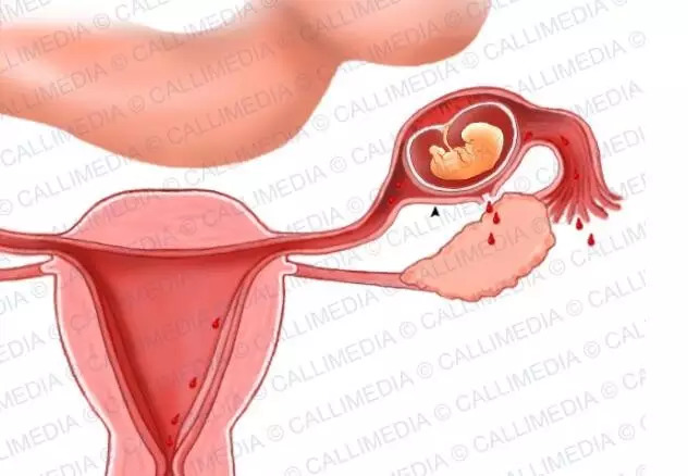 宮外孕20天最明顯的征兆，宮外孕20天的明顯征兆，早期識別與應(yīng)對的關(guān)鍵時刻