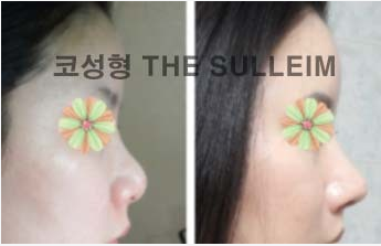 如何縮小鼻翼不手術(shù)，實(shí)用方法與建議，不手術(shù)縮小鼻翼的實(shí)用方法與建議