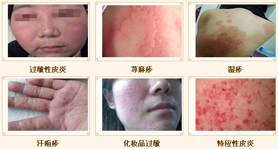 過敏性皮炎治愈方法，全面解析與應(yīng)對(duì)策略，過敏性皮炎全面解析，治愈方法與應(yīng)對(duì)策略