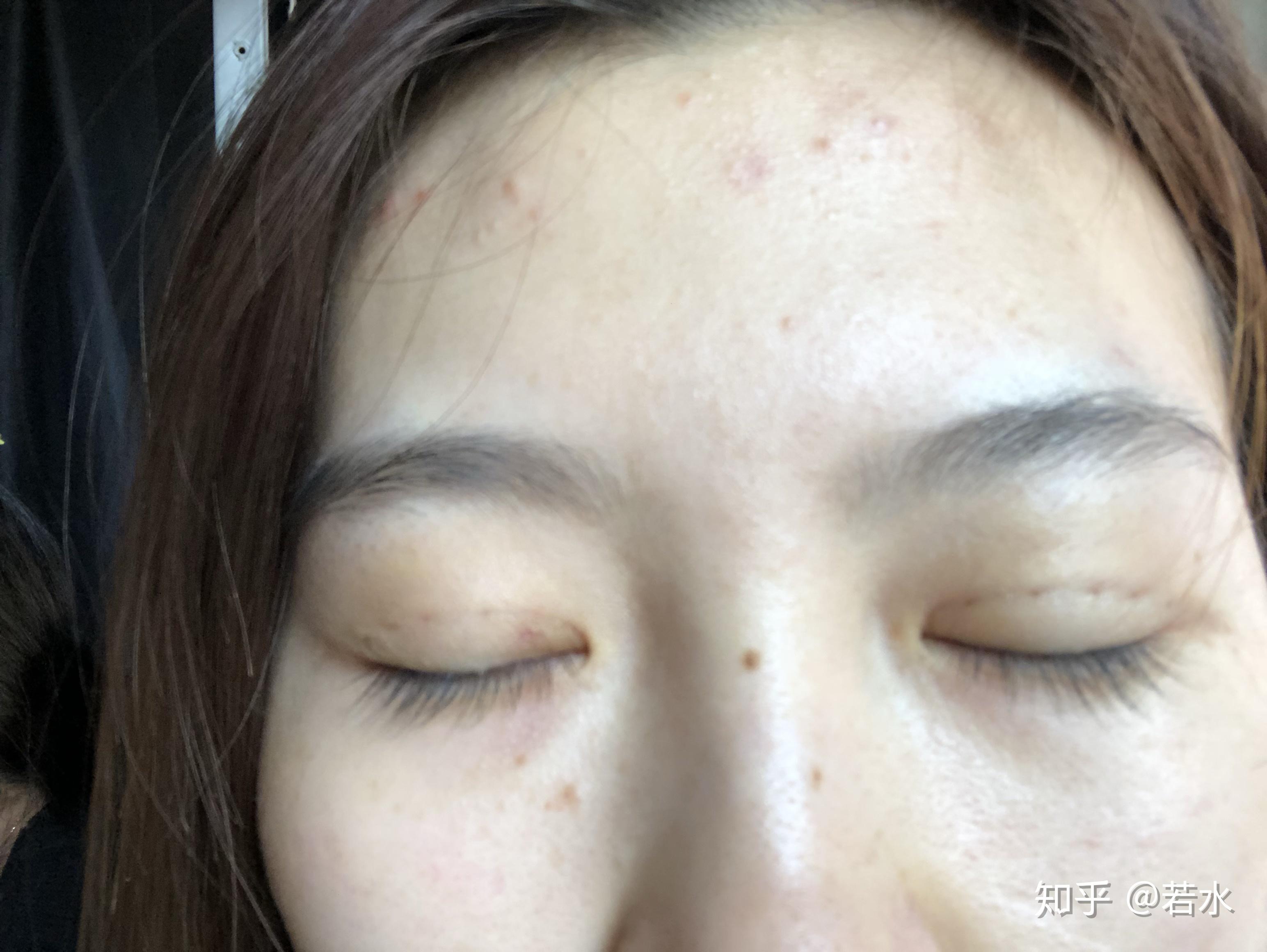 雙眼皮埋線手術效果持久性解析，持續(xù)時間與影響因素探討，雙眼皮埋線手術的持久性與影響因素深度解析