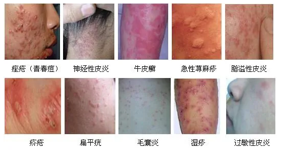 神經(jīng)性皮炎藥物治療指南，探尋最佳用藥方案，神經(jīng)性皮炎藥物治療指南，探尋最佳用藥方案及策略