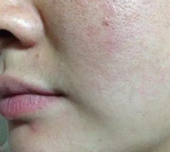 臉上毛孔粗大怎么辦？全方位解決方案助你擁有細(xì)膩肌膚，全方位解決毛孔粗大難題，讓你擁有細(xì)膩肌膚的秘訣！