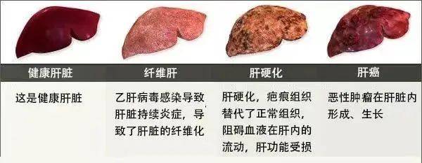 我的肝硬化三十年，經(jīng)歷、挑戰(zhàn)與希望，肝硬化三十年，我的經(jīng)歷、挑戰(zhàn)與希望的歷程
