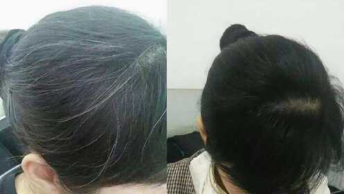 少白頭怎么調(diào)理變黑發(fā)——全方位指南，少白頭調(diào)理全攻略，如何有效變黑發(fā)？