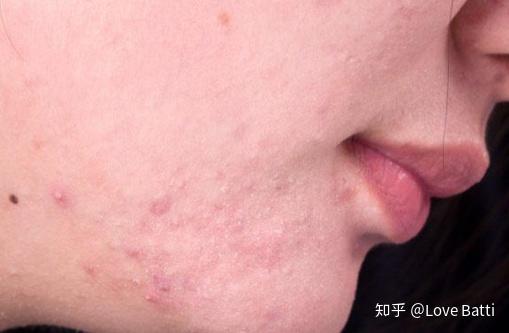 如何判斷臉上是否有螨蟲，全面解析與應對建議，全面解析，如何判斷臉上是否有螨蟲及應對建議