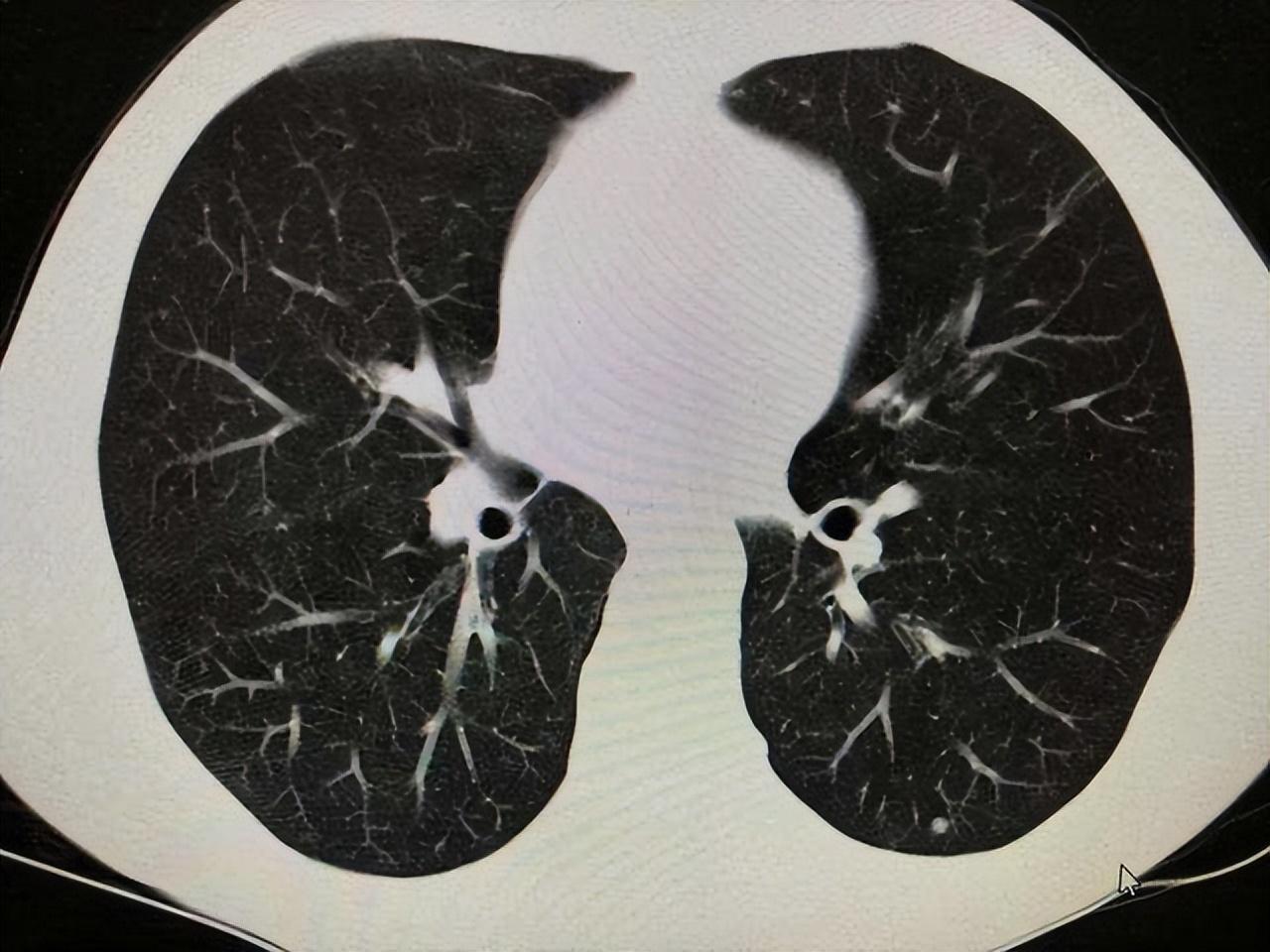 關(guān)于打科興后出現(xiàn)肺結(jié)節(jié)的探討，科興疫苗接種與肺結(jié)節(jié)關(guān)系探討