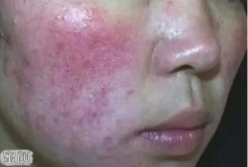 怎樣去除紅血絲最有效，全面解析紅血絲成因與有效去除方法，全面解析紅血絲成因及有效去除紅血絲的方法技巧