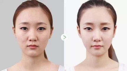 關于美白針多久打一次的全面解析，美白針注射頻率全面解析，多久打一次？