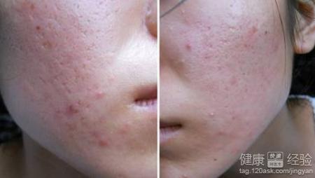 什么是痤瘡？一篇全面的SEO文章解析，全面解析，痤瘡的定義與防治——專業(yè)SEO文章解讀