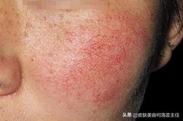 臉上有紅血絲怎么辦？全面解析治療方法，全面解析臉上紅血絲的治療方法