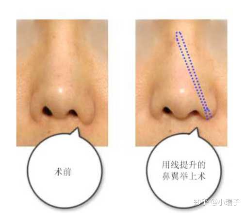 縮小鼻翼的方法，有效改善鼻翼過大的實用指南，縮小鼻翼的有效方法，實用指南助你改善鼻翼過大問題
