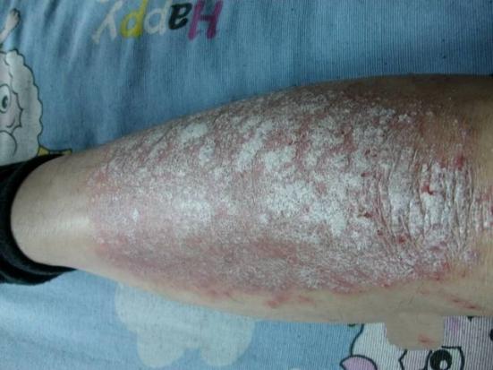 銀屑病初期癥狀圖片解析，了解銀屑病從初始階段開始，銀屑病初期癥狀詳解，圖片解析助你早期識別銀屑病